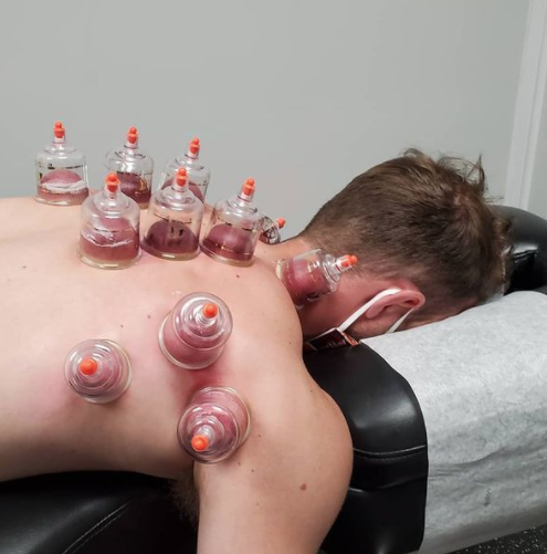 man laying face down on a massage table with cupping tools all over his back
